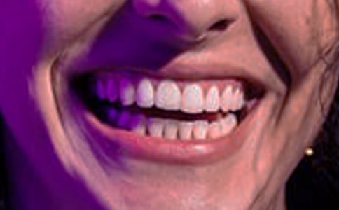 牙齦腫痛引起牙痛嚴(yán)重嗎